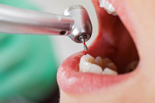 Best Emergency Tooth Extraction in Crouch Mesa, NM